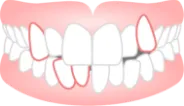 ガタガタの歯並び永久歯が変な場所にある